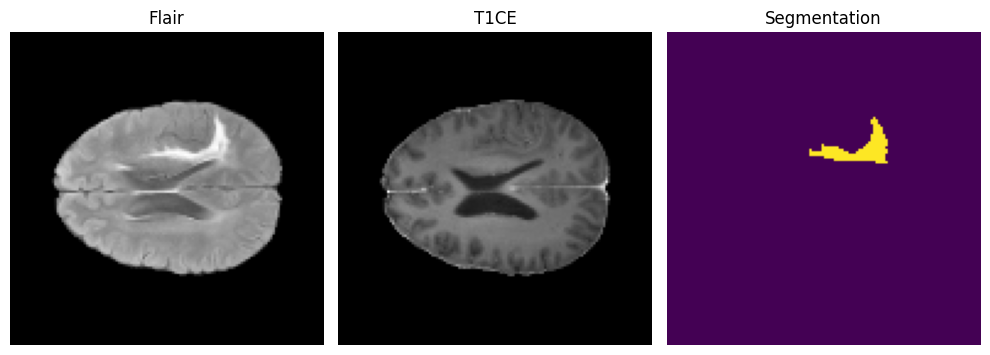 FLAIR, T1CE, and segmentation mask